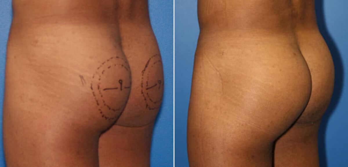 Gluteal Augmentation Before and After Photos in New York, NY, Patient 16552