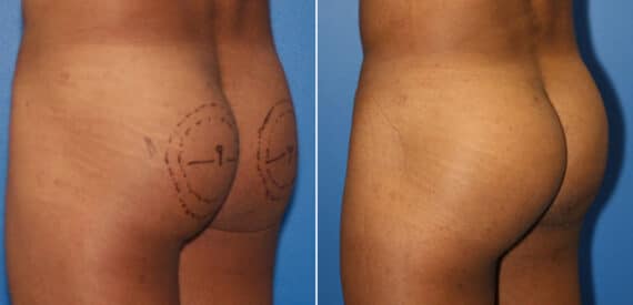 Gluteal Augmentation Before and After Photos in New York, NY, Patient 16552