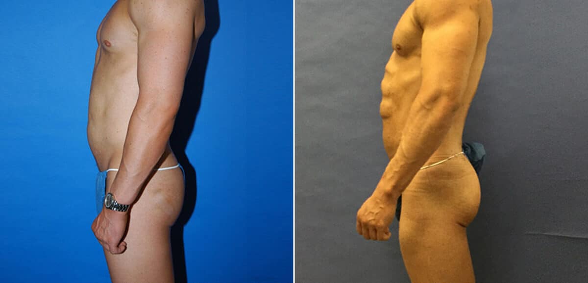 Gluteal Augmentation Before and After Photos in New York, NY, Patient 16464