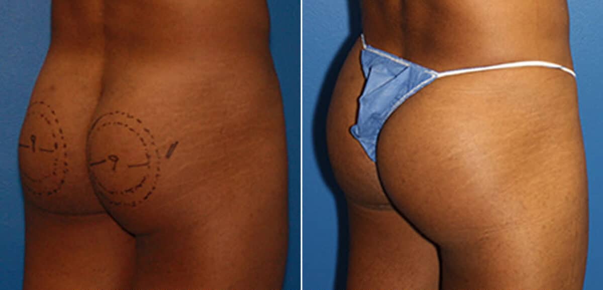 Gluteal Augmentation Before and After Photos in New York, NY, Patient 16552