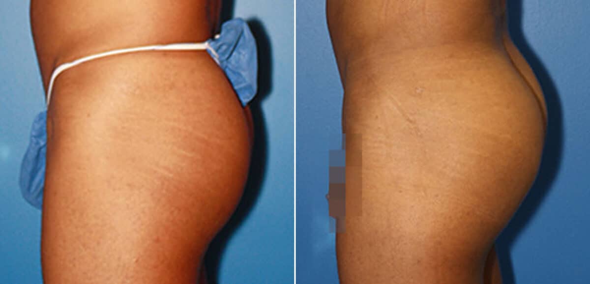 Gluteal Augmentation Before and After Photos in New York, NY, Patient 16552