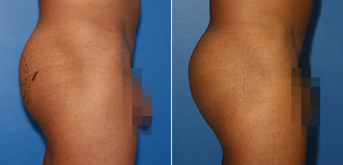 Gluteal Augmentation Before and After Photos in New York, NY, Patient 16552