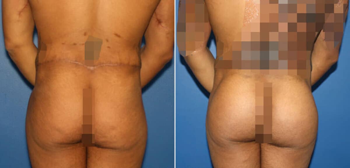 Gluteal Augmentation Before and After Photos in New York, NY, Patient 16568