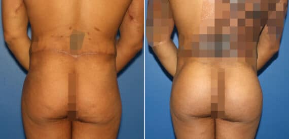 Gluteal Augmentation Before and After Photos in New York, NY, Patient 16568