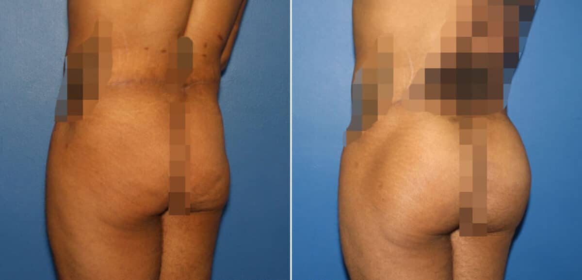 Gluteal Augmentation Before and After Photos in New York, NY, Patient 16568