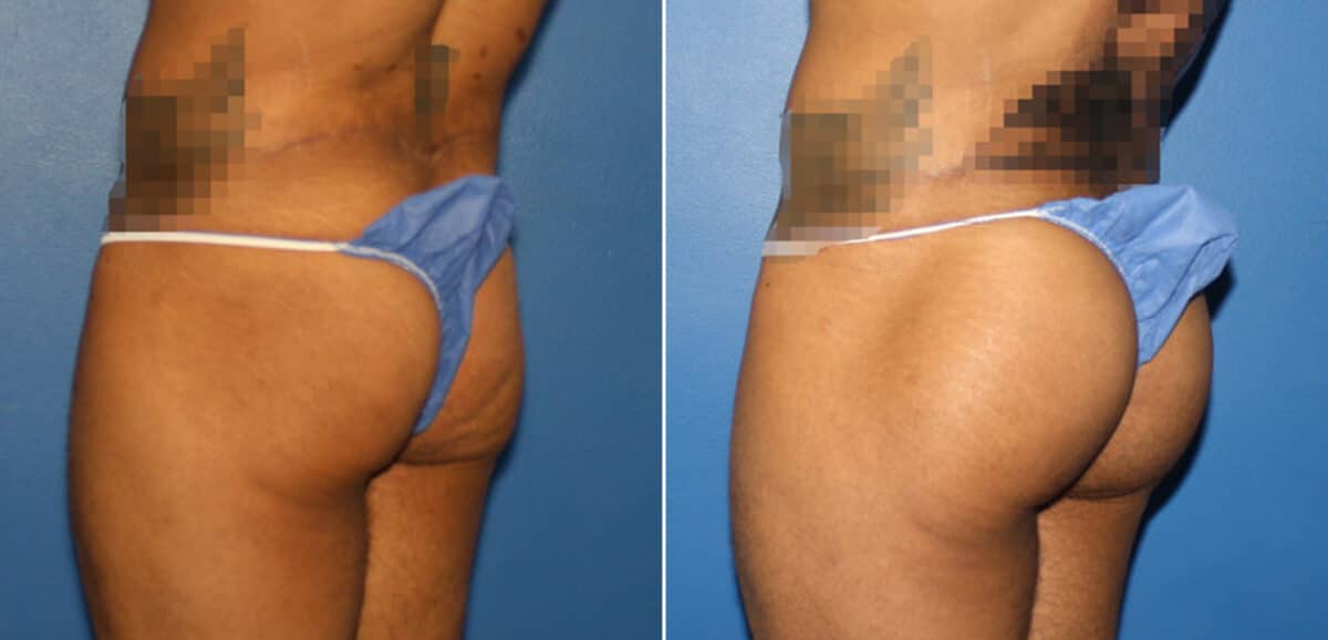 Gluteal Augmentation Before and After Photos in New York, NY, Patient 16568