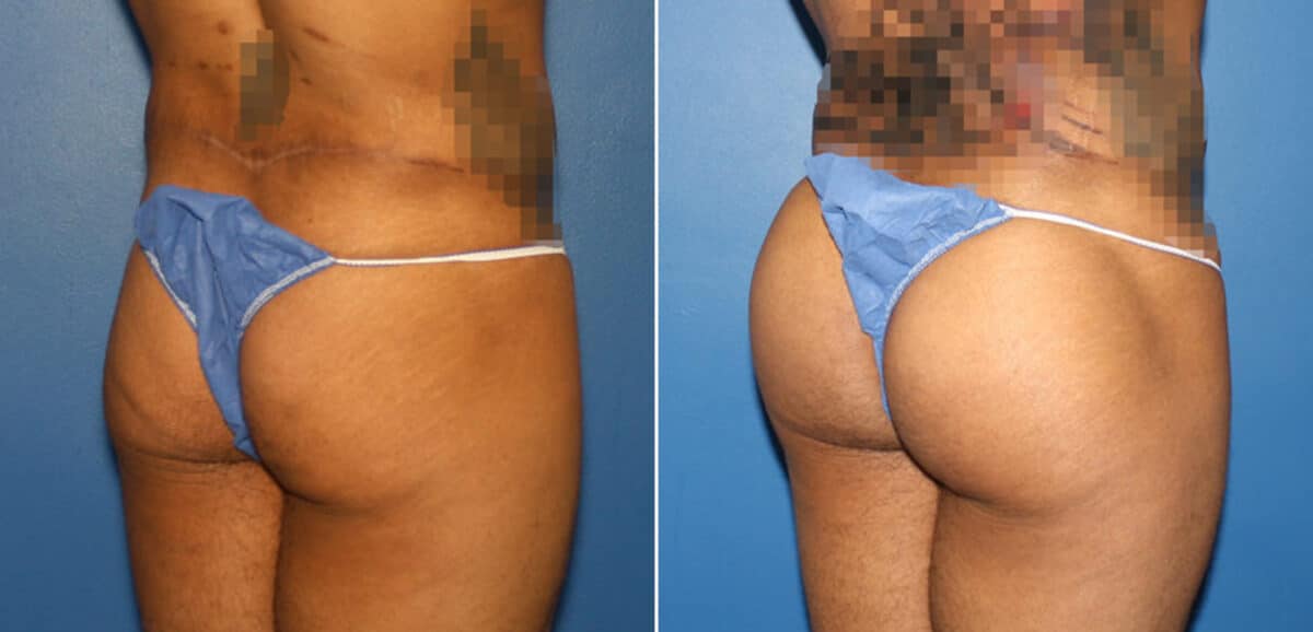 Gluteal Augmentation Before and After Photos in New York, NY, Patient 16568