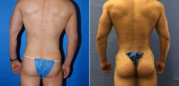 Gluteal Augmentation Before and After Photos in New York, NY, Patient 16464