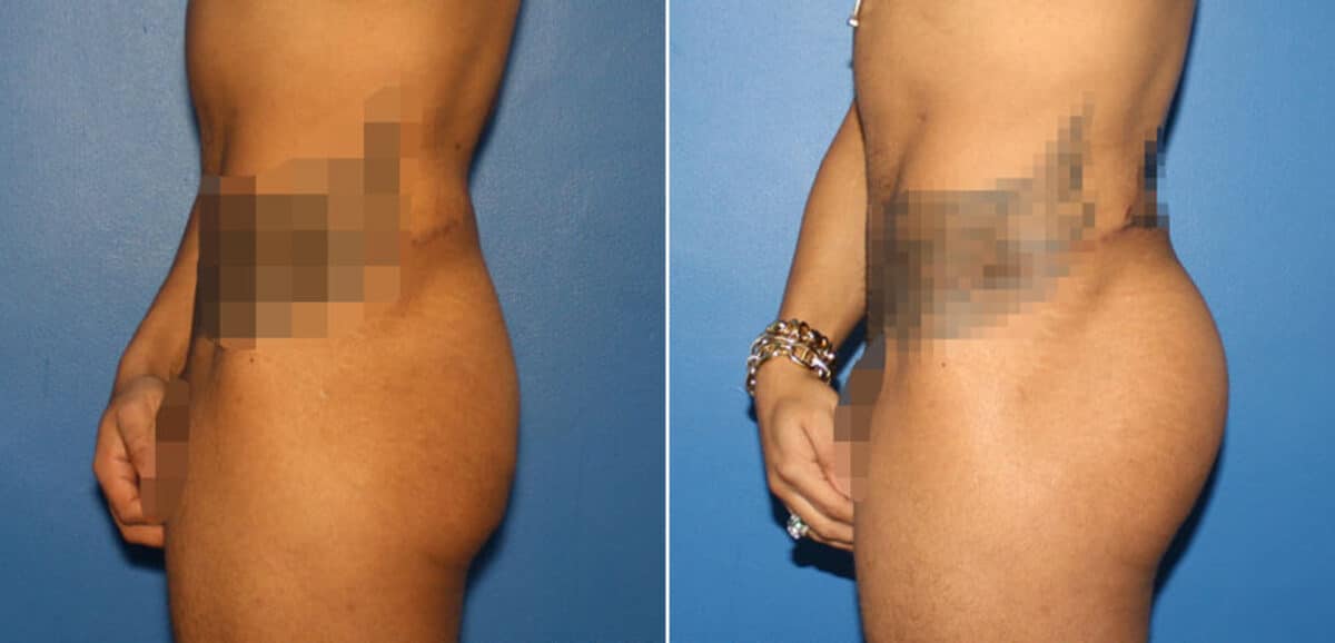 Gluteal Augmentation Before and After Photos in New York, NY, Patient 16568