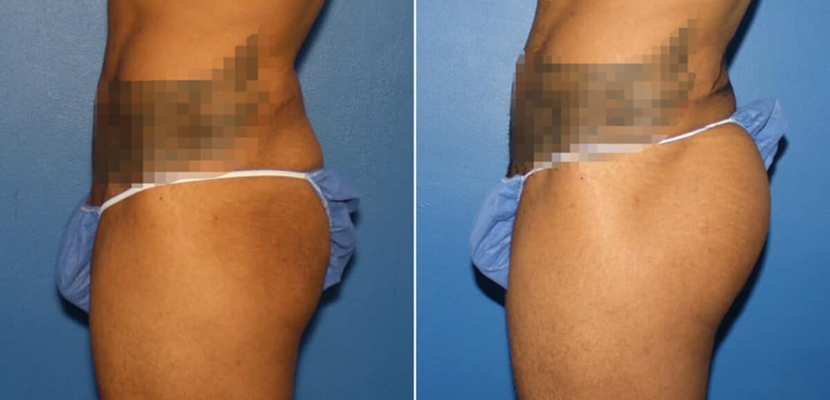 Gluteal Augmentation Before and After Photos in New York, NY, Patient 16568