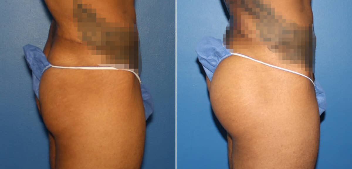 Gluteal Augmentation Before and After Photos in New York, NY, Patient 16568