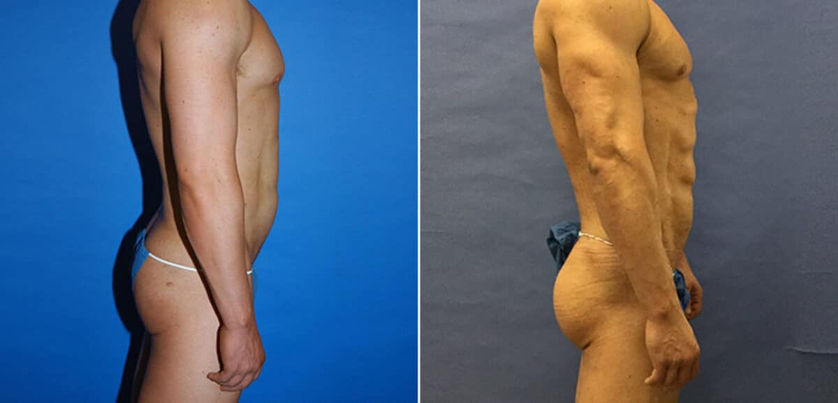 Gluteal Augmentation Before and After Photos in New York, NY, Patient 16464