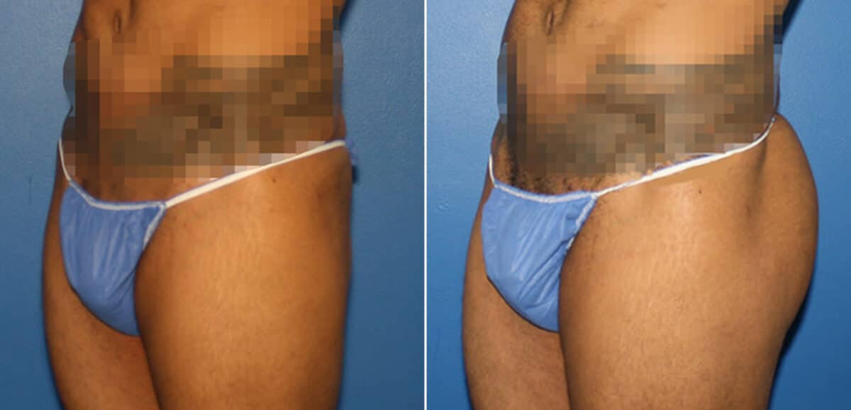 Gluteal Augmentation Before and After Photos in New York, NY, Patient 16568