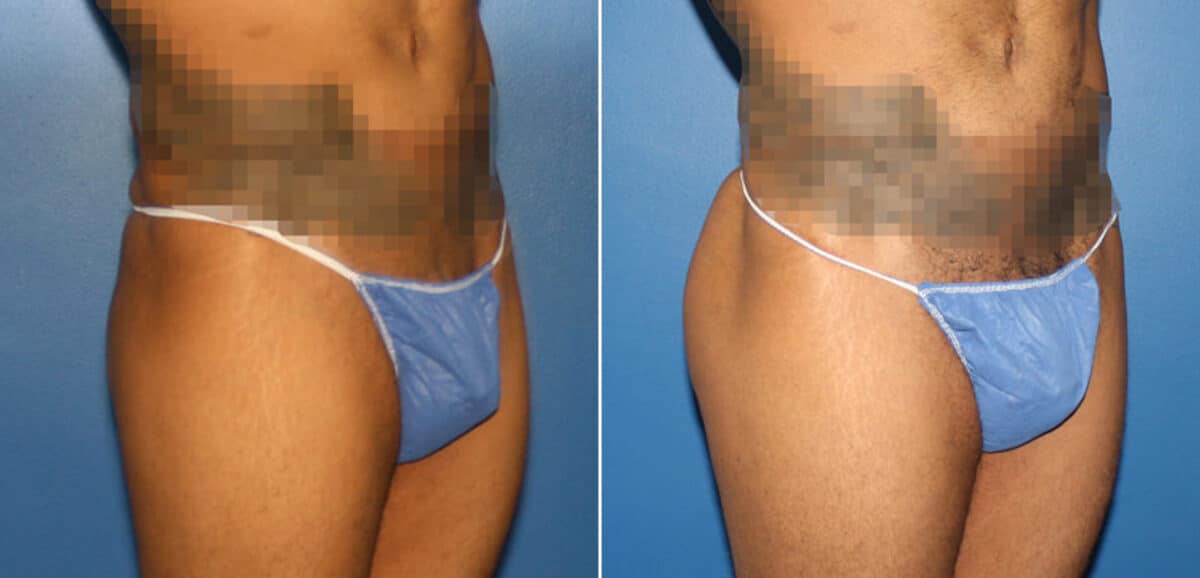 Gluteal Augmentation Before and After Photos in New York, NY, Patient 16568