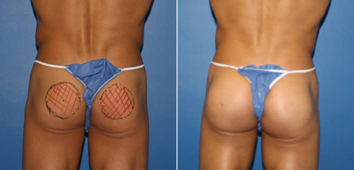 Gluteal Augmentation Before and After Photos in New York, NY, Patient 16596