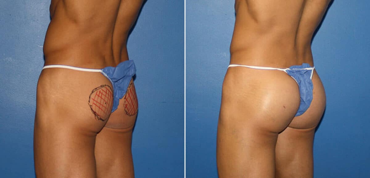 Gluteal Augmentation Before and After Photos in New York, NY, Patient 16596