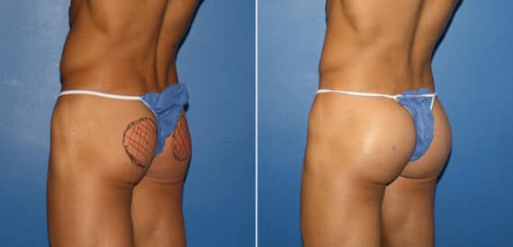 Gluteal Augmentation Before and After Photos in New York, NY, Patient 16596