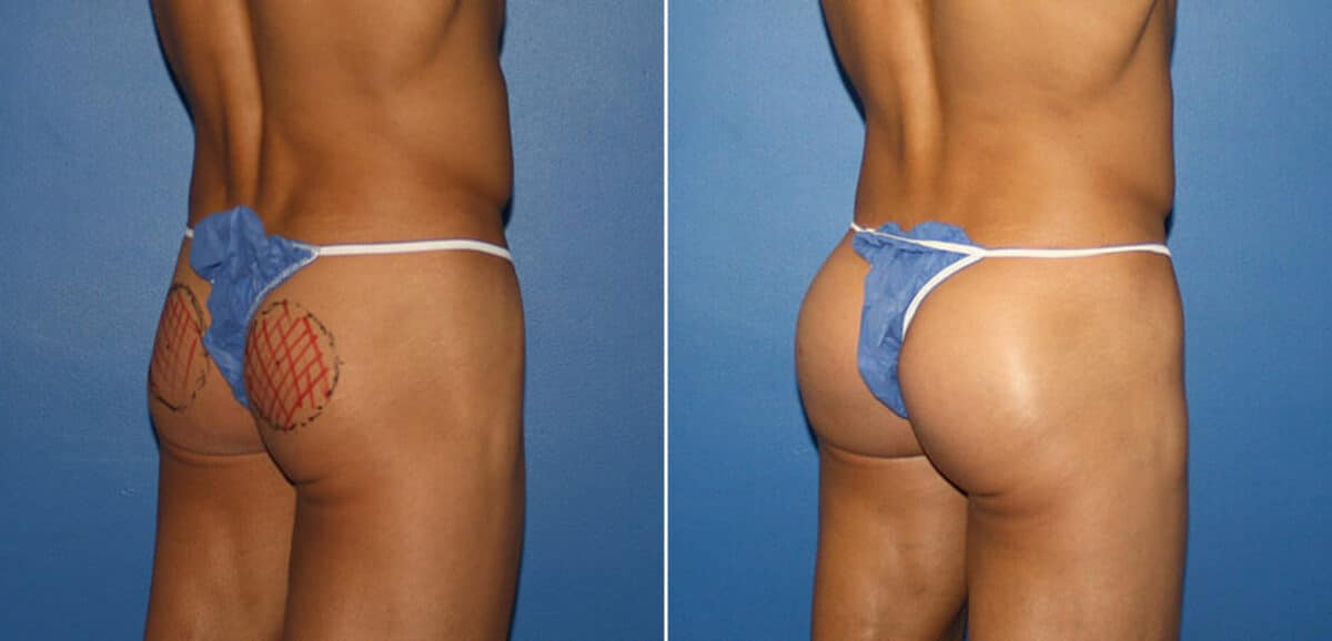 Gluteal Augmentation Before and After Photos in New York, NY, Patient 16596