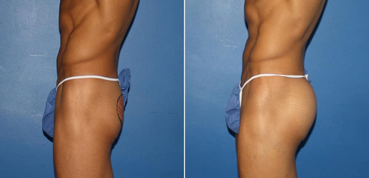 Gluteal Augmentation Before and After Photos in New York, NY, Patient 16596