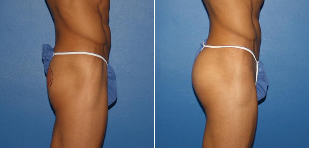 Gluteal Augmentation Before and After Photos in New York, NY, Patient 16596