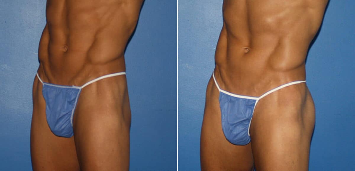Gluteal Augmentation Before and After Photos in New York, NY, Patient 16596