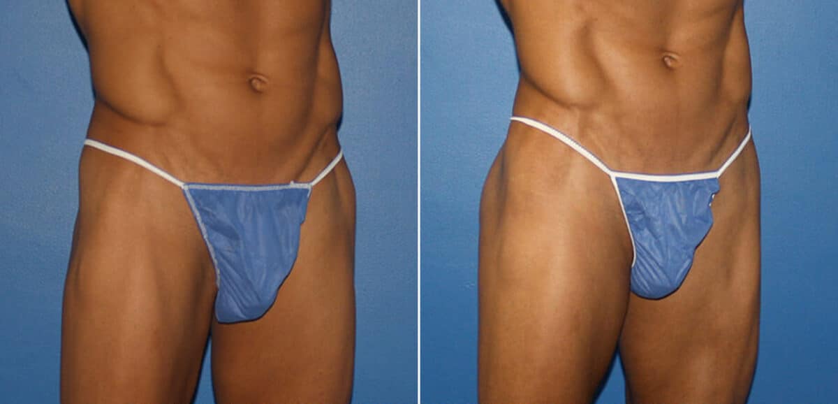 Gluteal Augmentation Before and After Photos in New York, NY, Patient 16596