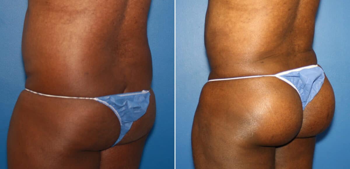 Gluteal Augmentation Before and After Photos in New York, NY, Patient 16618