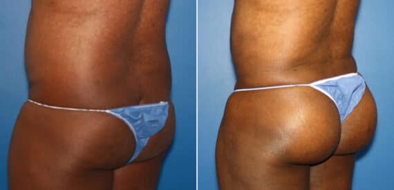 Gluteal Augmentation Before and After Photos in New York, NY, Patient 16618