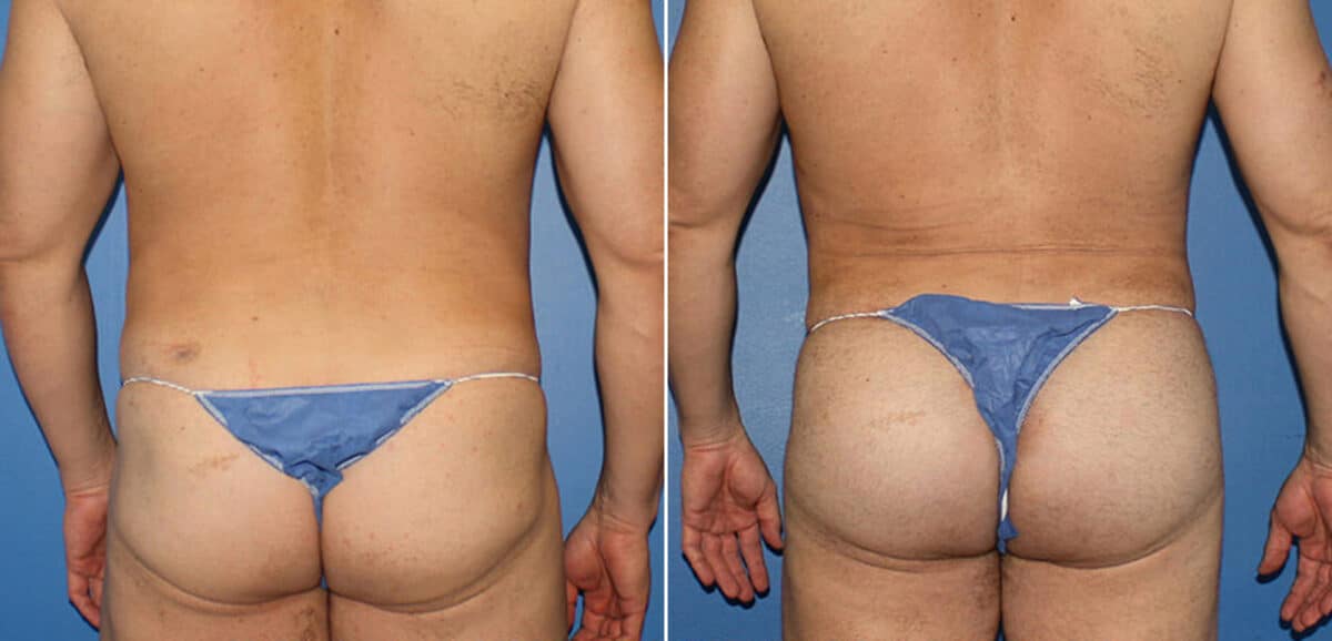 Gluteal Augmentation Before and After Photos in New York, NY, Patient 16480