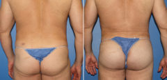 Gluteal Augmentation Before and After Photos in New York, NY, Patient 16480