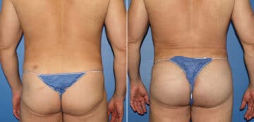 Gluteal Augmentation Before and After Photos in New York, NY, Patient 16480