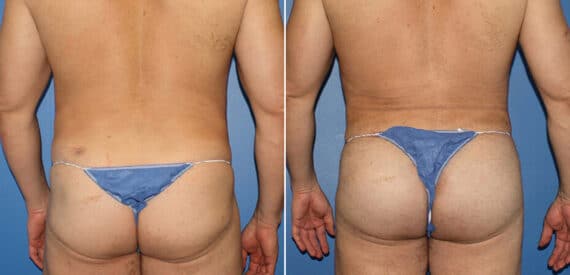 Gluteal Augmentation Before and After Photos in New York, NY, Patient 16480