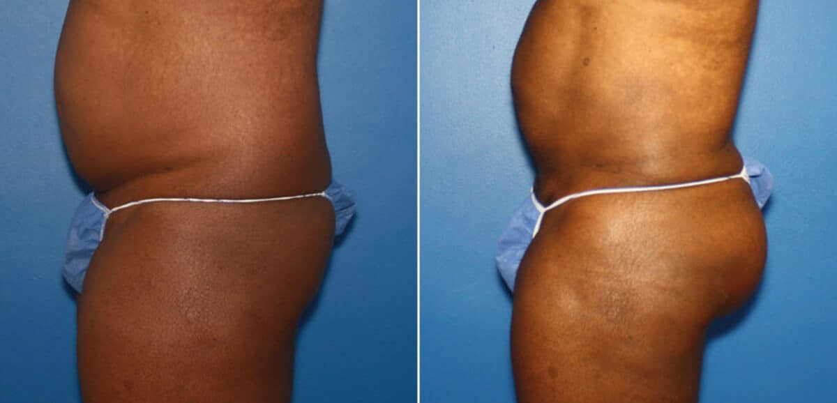 Gluteal Augmentation Before and After Photos in New York, NY, Patient 16618