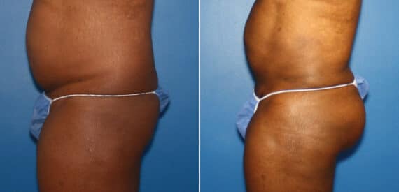 Gluteal Augmentation Before and After Photos in New York, NY, Patient 16618