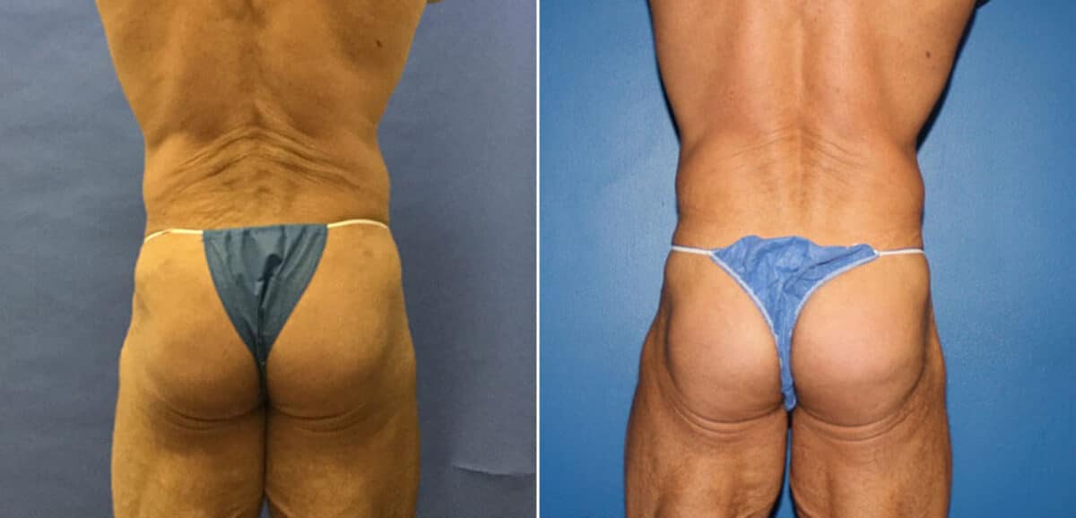 Gluteal Augmentation Before and After Photos in New York, NY, Patient 16626