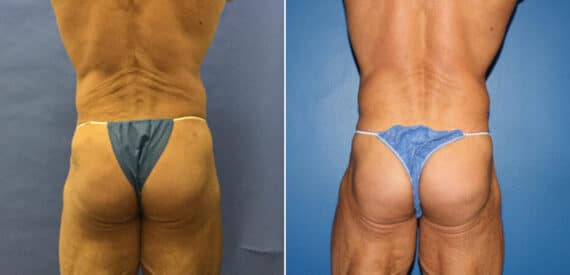 Gluteal Augmentation Before and After Photos in New York, NY, Patient 16626