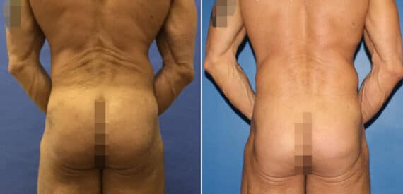 Gluteal Augmentation Before and After Photos in New York, NY, Patient 16626