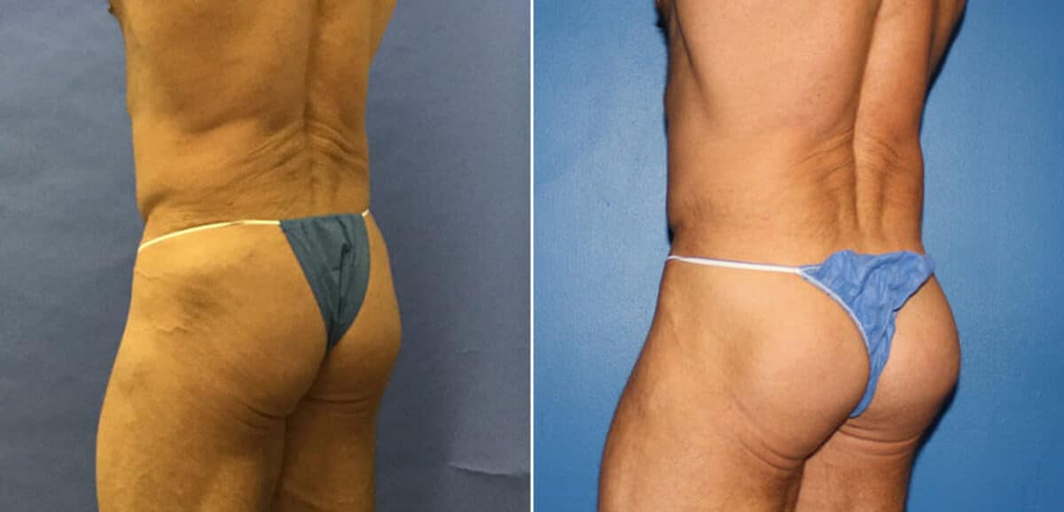 Gluteal Augmentation Before and After Photos in New York, NY, Patient 16626