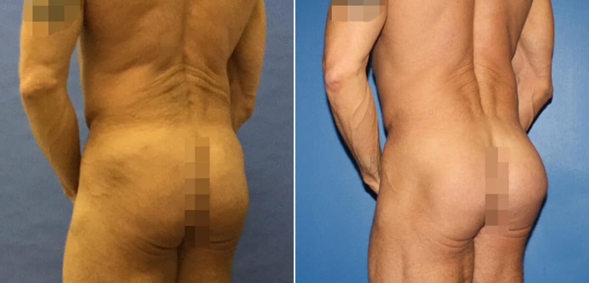 Gluteal Augmentation Before and After Photos in New York, NY, Patient 16626
