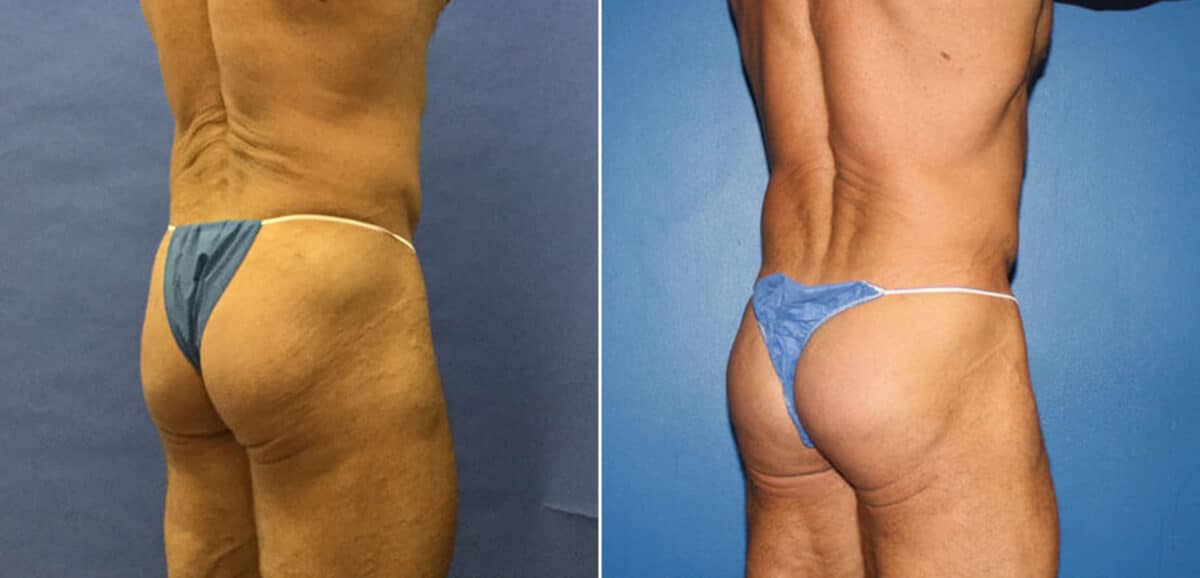 Gluteal Augmentation Before and After Photos in New York, NY, Patient 16626