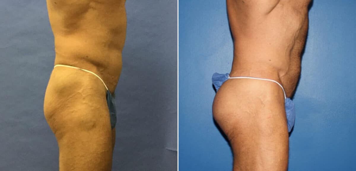 Gluteal Augmentation Before and After Photos in New York, NY, Patient 16626