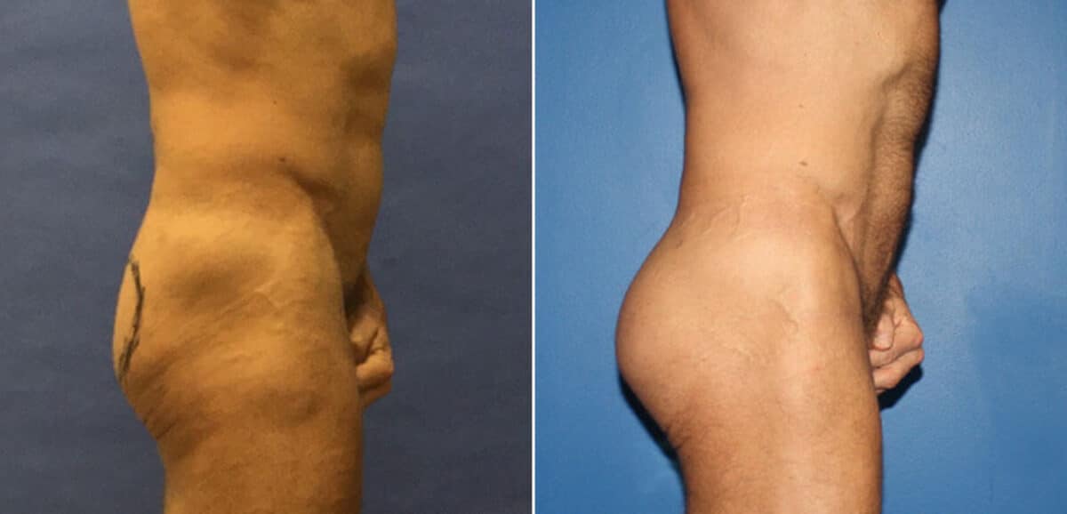 Gluteal Augmentation Before and After Photos in New York, NY, Patient 16626