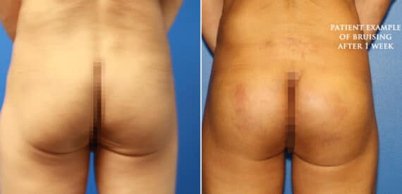 Gluteal Augmentation Before and After Photos in New York, NY, Patient 16648