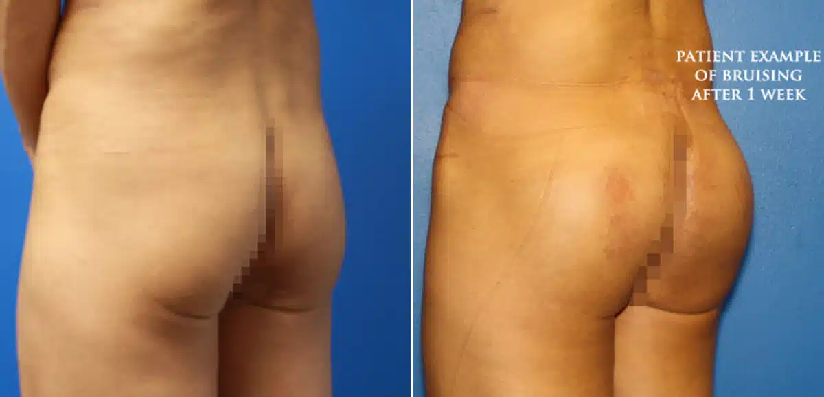 Gluteal Augmentation Before and After Photos in New York, NY, Patient 16648