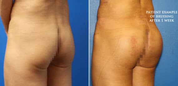 Gluteal Augmentation Before and After Photos in New York, NY, Patient 16648