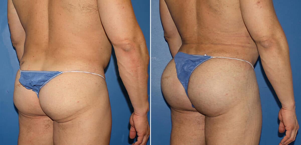 Gluteal Augmentation Before and After Photos in New York, NY, Patient 16480