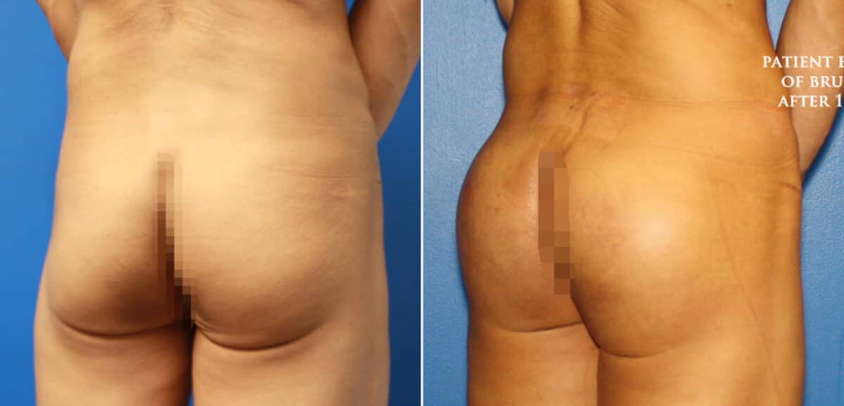 Gluteal Augmentation Before and After Photos in New York, NY, Patient 16648