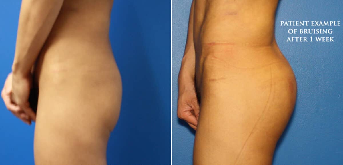 Gluteal Augmentation Before and After Photos in New York, NY, Patient 16648