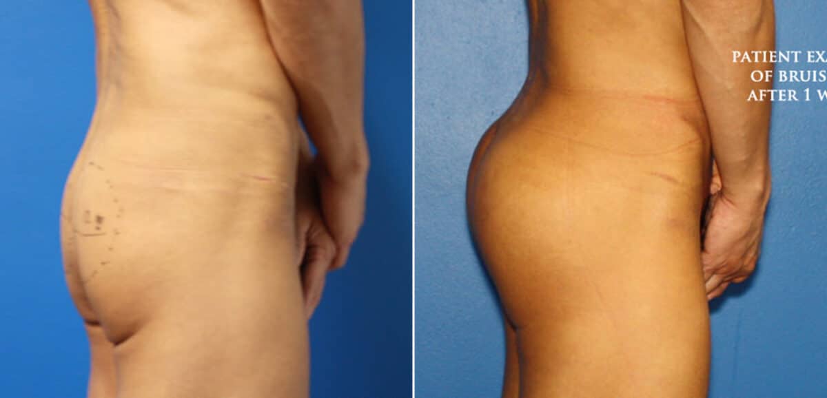 Gluteal Augmentation Before and After Photos in New York, NY, Patient 16648