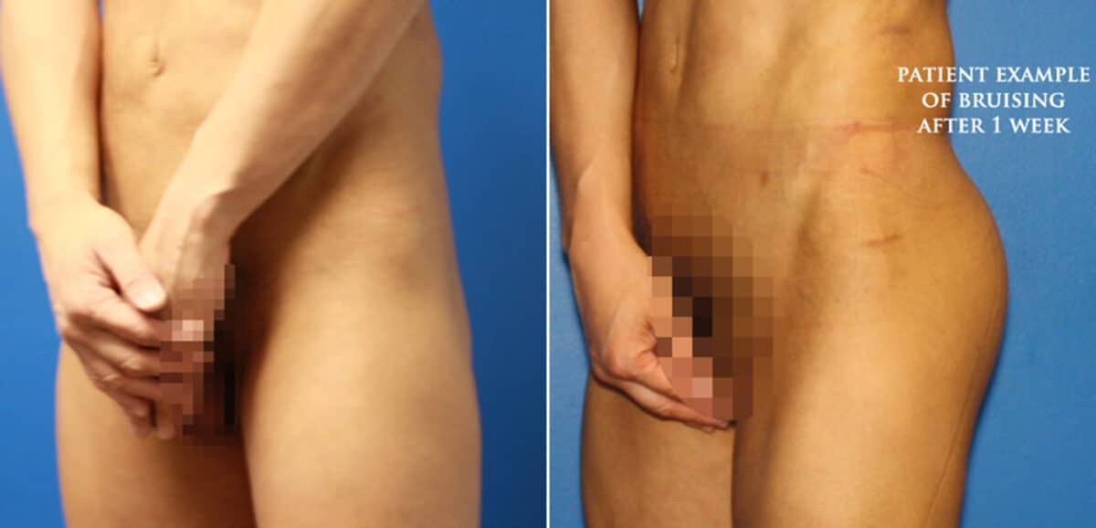 Gluteal Augmentation Before and After Photos in New York, NY, Patient 16648